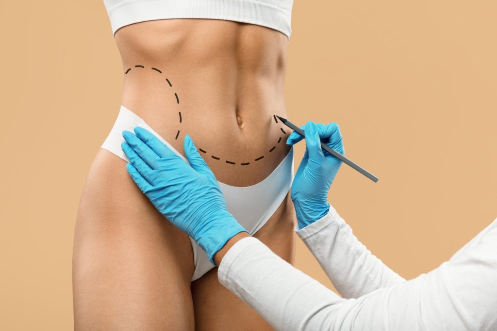 liposuction
