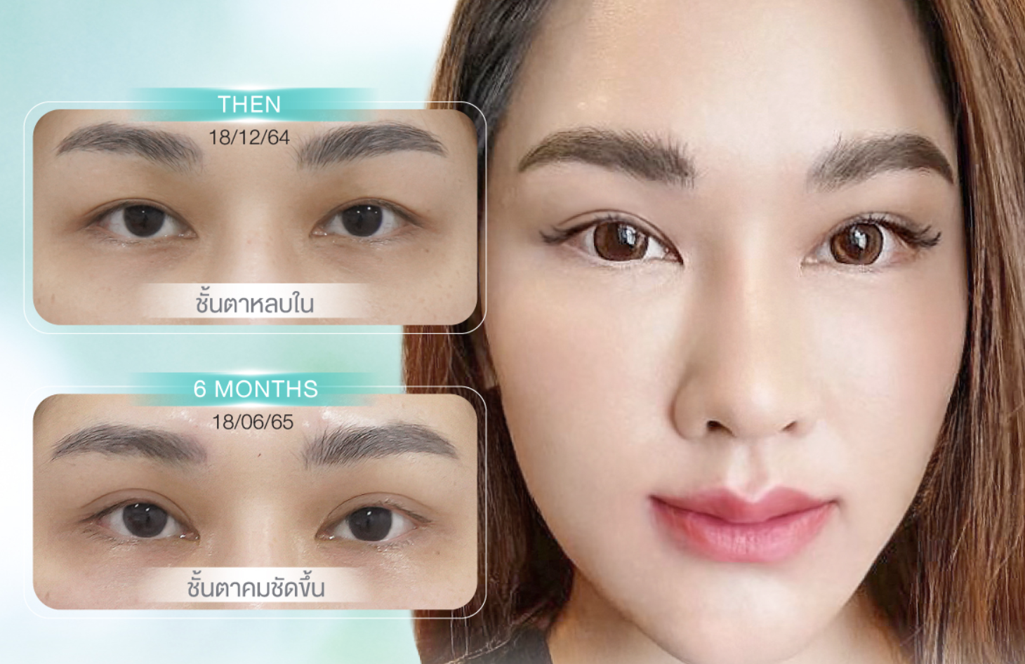 ศัลยกรรม ทำตาสองชั้น