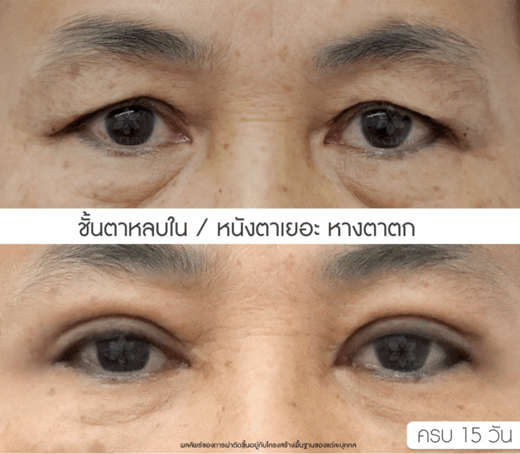 ศัลยกรรม ทำตาสองชั้น
