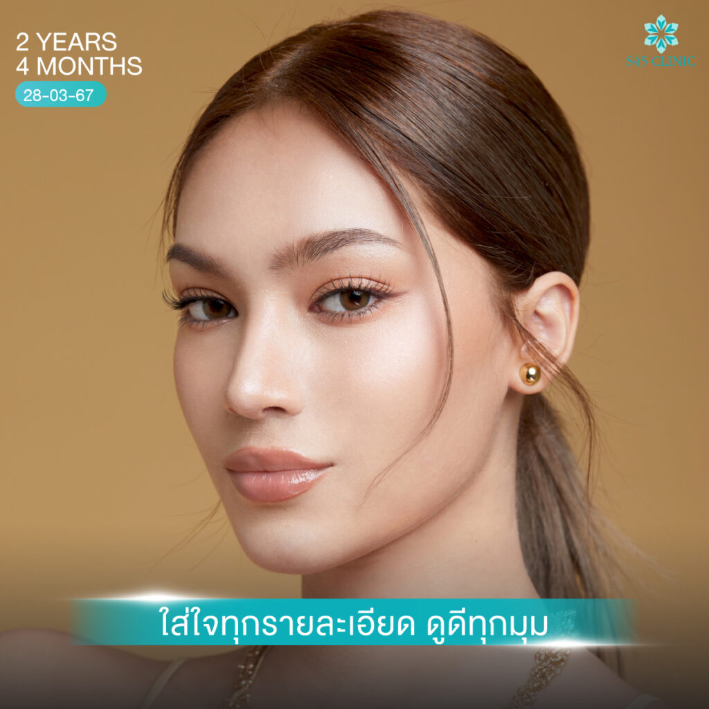 เสริมจมูก หมอตี้ 